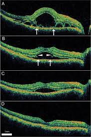 Retinal Disease Diagnosis using OCT